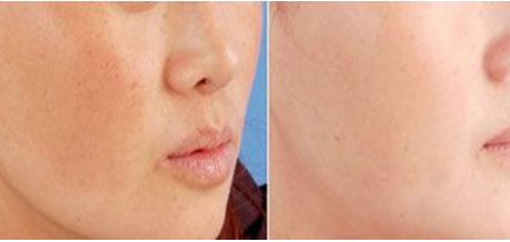 朱海男全切雙眼皮手術(shù)費用及醫(yī)生簡介、價格表解析！