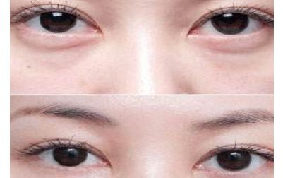 北京張笑天的下頜角手術(shù)技術(shù)及豐碩成果曝光！醫(yī)術(shù)精湛，案例展示震撼人心