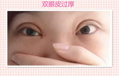 鄭州東方整形醫(yī)院大腿吸脂術(shù)：醫(yī)生解讀及成功案例分享