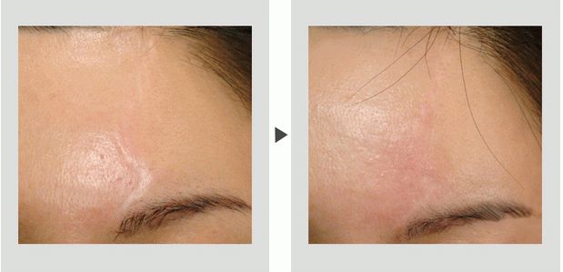 北京八大處哪個整形醫(yī)院的雙眼皮手術(shù)效果好？推薦醫(yī)生和價格！