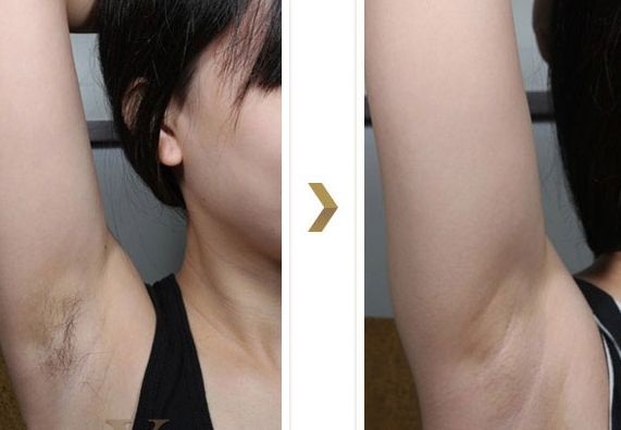 長沙湘雅醫(yī)院的減肥科如何？大腿吸脂效果如何？