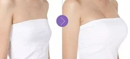 成都華美邱偉醫(yī)師分享隆鼻案例，鼻部塑造效果驚艷！