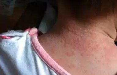 黃開亮眼睛美不美，醫(yī)生經(jīng)驗(yàn)公開！看雙眼皮整形成功案例