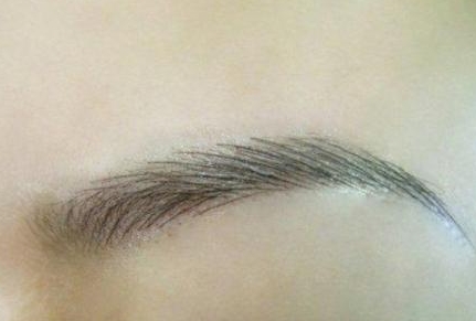 南方醫(yī)院陳兵拉皮手術(shù)真的值得選擇嗎？