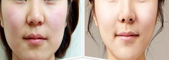 崔寓植鼻子效果如何？這個(gè)案例真實(shí)又自然！
