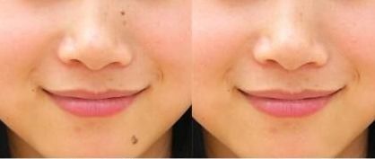 上海九院李茅醫(yī)生的雙眼皮手術(shù)效果如何？90天見證分享給你！