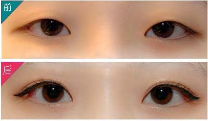 九院朱海男雙眼皮手術效果與價格一覽，了解最新資訊！