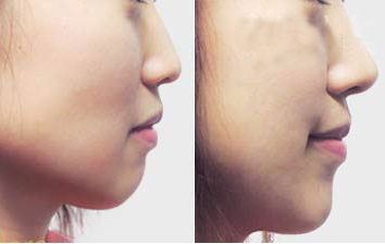 珠海采用新技術(shù)，瞬間消除黑眼圈的專業(yè)美容醫(yī)院預(yù)約