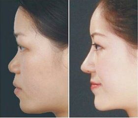 成都邱偉醫(yī)生雙眼皮術的成功案例分享