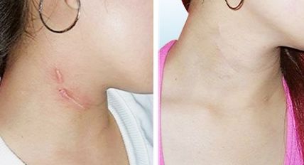 蘭州亞韓雙眼皮整形費用一覽，談談手術技巧與費用