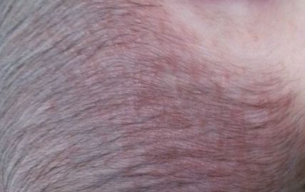 大慶彤銘醫(yī)學(xué)美容診所：體驗(yàn)吸脂手術(shù)的醫(yī)生詳解與術(shù)后心得分享