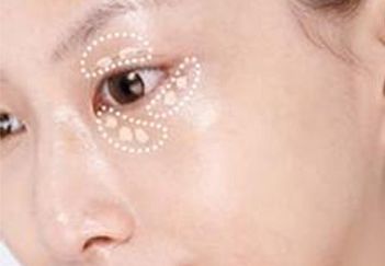 杭州葉秀娣做雙眼皮具體效果如何？專家實(shí)踐案例發(fā)布