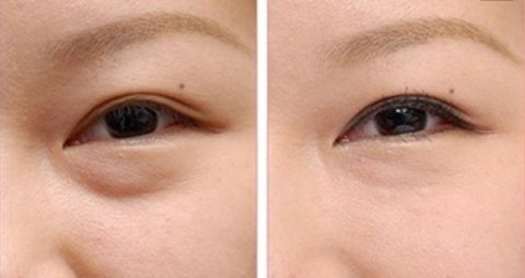 成都李烈療法注脂面部效果令人驚嘆！實(shí)例揭秘