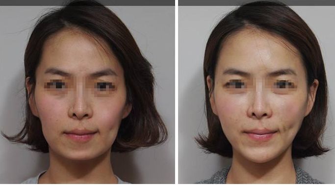 深圳頂級乳房整形專家團隊？權(quán)威醫(yī)院解答哪家三甲醫(yī)院最適合隆胸