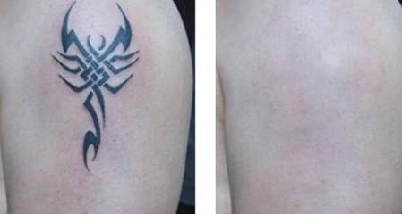 宋建星吸脂修復效果好嗎？吸脂修復宋建星技術如何？