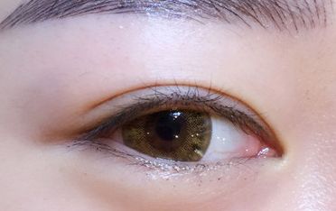 鄒翀，這一雙眼皮技術(shù)，近期有所革新