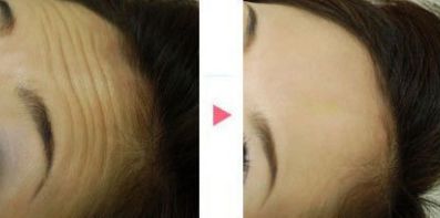 成都藝星周順波做鼻整形效果及費用詳解