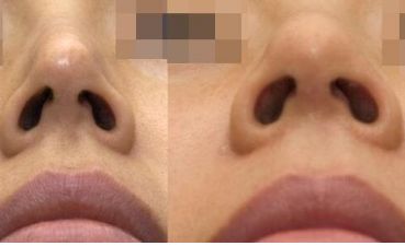 南寧整形醫(yī)院治療疤痕效果如何？最佳選擇揭秘