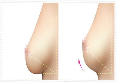 哈爾濱醫(yī)大一院乳房隆胸技藝揭秘！最新案例驚艷發(fā)布