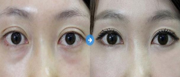 盤點北京7大值得信賴的開眼角整形醫(yī)生