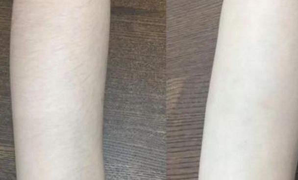 宜賓第一人民醫(yī)院的無痛隆鼻案例分享及費用公示