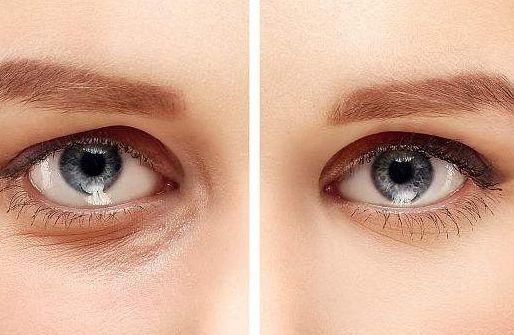 華西醫(yī)院整形科伍俊良醫(yī)生眼袋手術(shù)的技術(shù)與案例分享