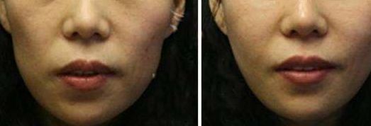 洛陽市第三人民醫(yī)院整形科雙眼皮效果如何？2023真實(shí)案例分享