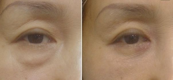 北京八大處趙延勇醫(yī)生的雙眼皮手術(shù)如何？了解醫(yī)院背景和手術(shù)案例。