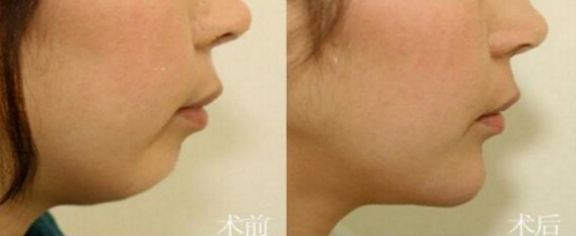 成都這7家專業(yè)豐胸醫(yī)院，不可錯(cuò)過(guò)的排名第一