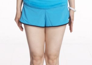 口碑醫(yī)師揭秘｜2023年易陽(yáng)艷割雙眼皮價(jià)格曝光