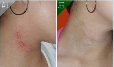 廣州隆胸手術費用及案例分享，口碑如何？