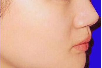 南京施爾美劉衛(wèi)豐鼻匠：獨(dú)具實(shí)力，成功案例揭秘！