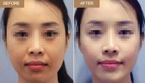 廈門五家口碑佳的隆鼻醫(yī)院，實力皆不俗