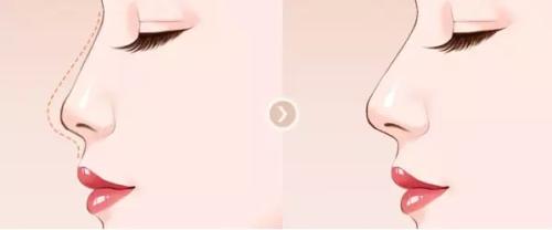 寧波韓美整形吸脂值得信賴嗎？