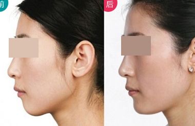 上海哪個(gè)醫(yī)生擅長鼻翼縮??？2023年度網(wǎng)民口碑推薦醫(yī)生名冊(cè)曝光