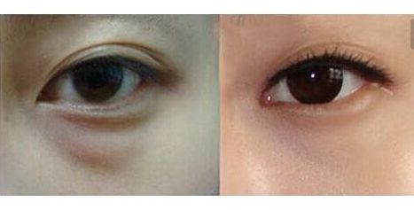 羅日云整容醫(yī)生的服務(wù)及費(fèi)用詳情，隱私公開！優(yōu)質(zhì)雙眼皮案例與收費(fèi)一覽供參考！