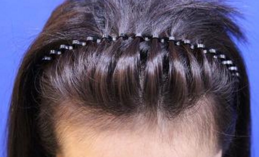 雙眼皮手術如何才能達到自然效果？需要注意哪些飲食禁忌？