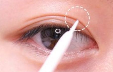 北京美聯(lián)臣路世敏醫(yī)生幫你告別歲月痕跡！除皺案例分享！