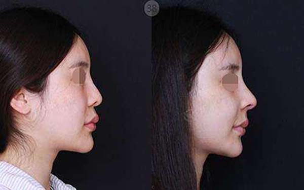 重慶美萊整形四月特惠，是不是只需6000元即可減400元？雙眼皮可以實現(xiàn)嗎？