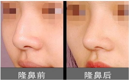 上海柴云醫(yī)生雙眼整形效果完美！手術前后真實照片呈現(xiàn)出專業(yè)水平