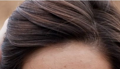 南昌二附院整形科眼袋抽脂效果好嗎？值得醫(yī)生推薦嗎？