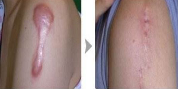 武漢仁愛時(shí)光醫(yī)療美容醫(yī)院優(yōu)質(zhì)案例分享，自體脂肪隆胸效果如何？