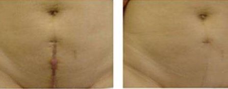 重慶張恒術(shù)進(jìn)行雙眼皮手術(shù)，醫(yī)生實(shí)力以及成功案例展示