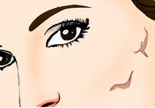 張曉建拉皮的效果好不好？如何評價？