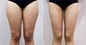 浙江杭州有沒有靠譜的鵬愛整形醫(yī)院？頂尖專家現(xiàn)身說法！