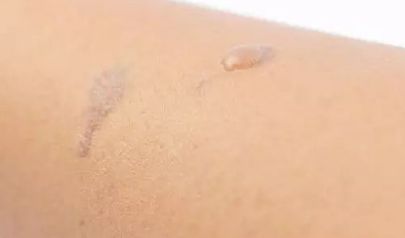 整形醫(yī)生楊小順在鄭州陽光創(chuàng)美進(jìn)行眼部手術(shù)口碑如何？