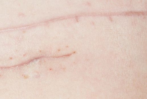 桂林華美醫(yī)院：胡凱鼻子整形前后效果大揭秘！看圖真相引人矚目