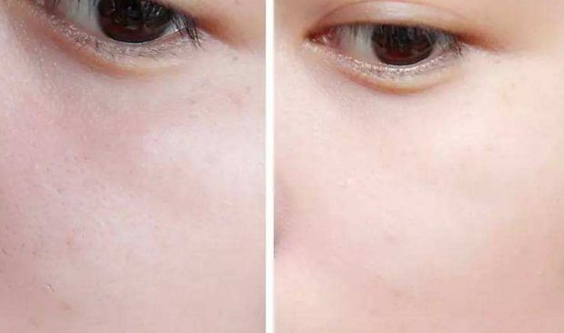 南京懿佳劉育鳳教您輕松擁有雙眼皮！專家妙手將為您呈現(xiàn)無(wú)數(shù)成功案例！