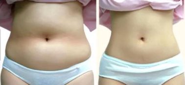 成都最佳面部吸脂醫(yī)生排名揭曉！八大靠譜醫(yī)生名單引爆話題！