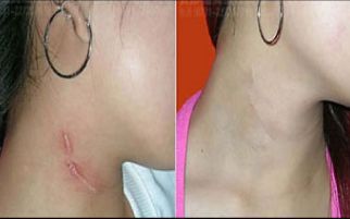 北京首都整形醫(yī)院雙眼皮修復(fù)效果如何？詳細(xì)案例揭秘